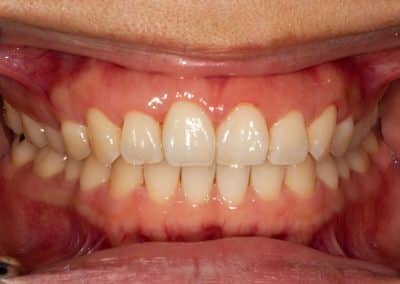 Healthy gums with a pink colour and no sign of bleeding or swelling. These teeth have not incurred any loss of gum or bone attachment. The teeth are firm with no mobility.