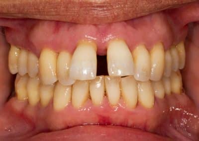 Periodontitis has resulted in the recession of gum around multiple teeth. The loss of bone and gum support around the teeth has led to drifting away from their original position. Large gaps are appearing between teeth.