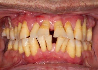 Here we see the gums appearing extremely swollen and the progressive loss of bone around the teeth has resulted in significant displacement and drifting of the teeth. Teeth are beginning to develop painful abscesses and have become considerably loose.