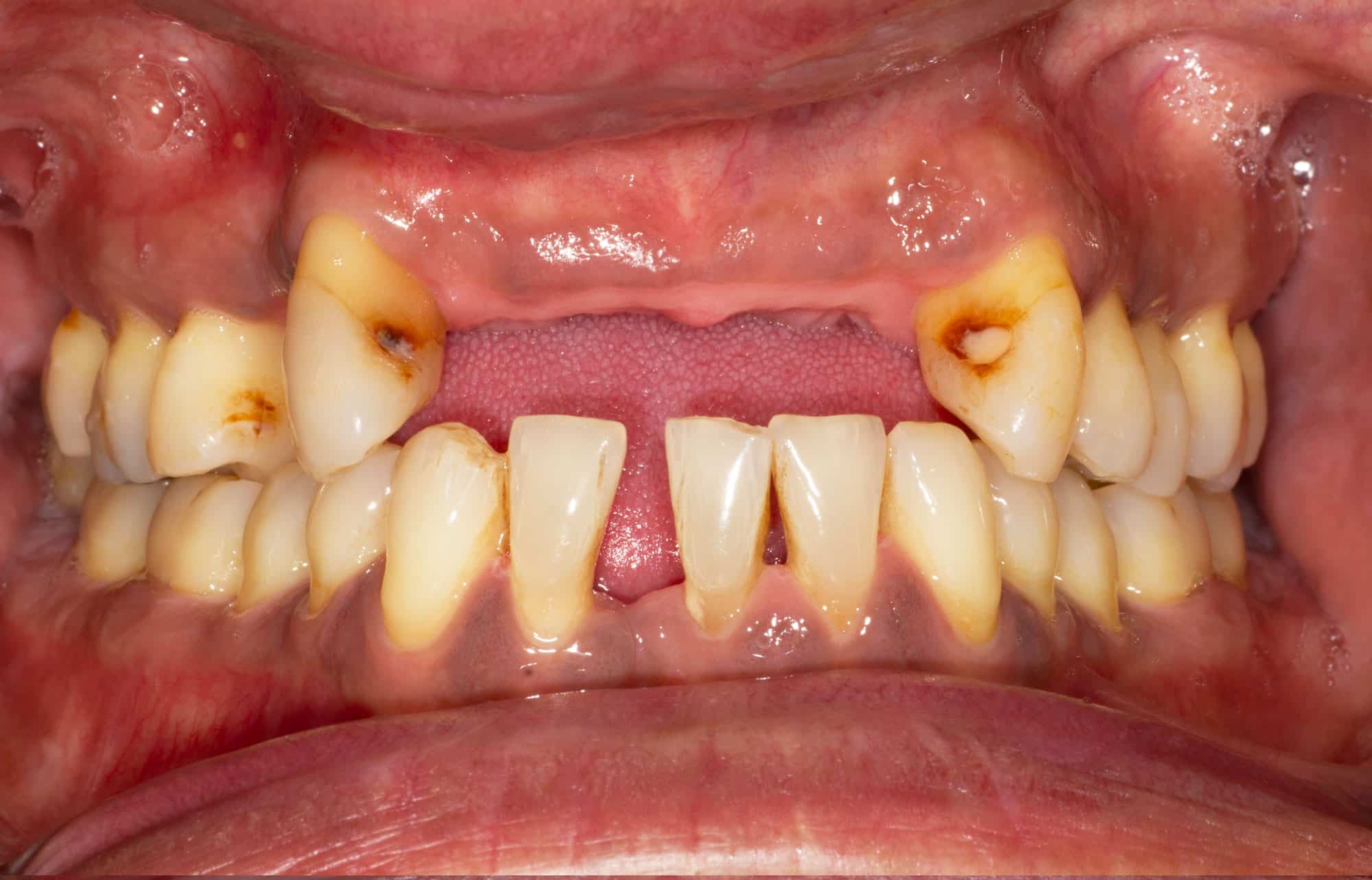 Gum Disease Treatment In London Grdc