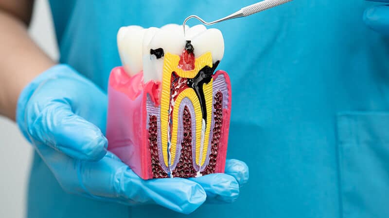 What to Expect Before, During, and After a Root Canal