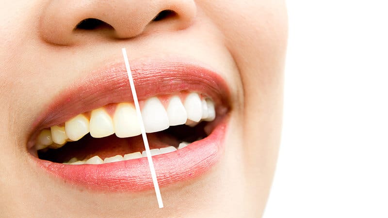 Teeth whitening, before and after image