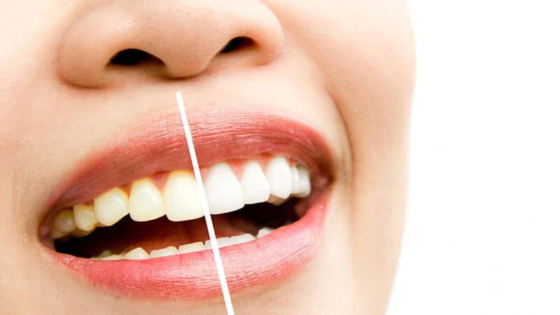 Teeth whitening - before and after