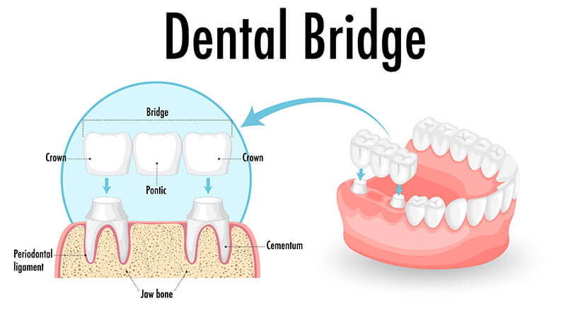 dental-bridge-info Dental bridge infographic