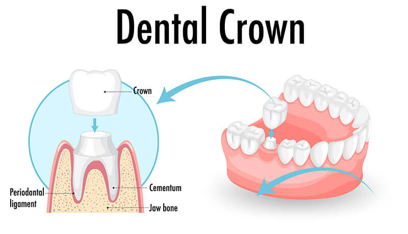 dental-crown-info Dental crown infographic